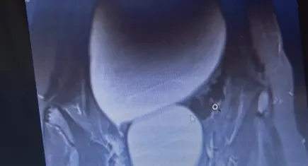 Doktorlar bile gözlerine inanamadı: 12 yaşındaki çocuğun karnından kavun büyüklüğünde kist çıktı