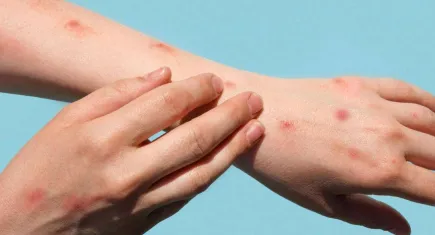 Hekimler mpox’tan ne zaman şüphelenmeli?