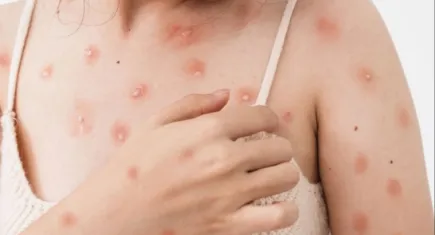 Ülkemizde vaka görülmedi ama uzmanlar uyardı: Tedbiri elden bırakmayın!