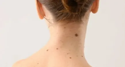 Dermatoloji Uzmanından kış öncesi ben uyarısı